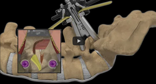 Maximum Access Surgery Transforaminal Lumbar Interbody Fusion